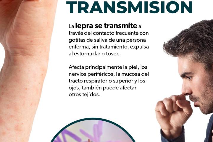 SSM se suma a acciones de lucha contra la lepra