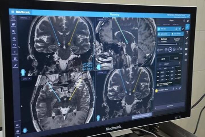 Promueve IMSS detección oportuna de enfermedad de Parkinson
